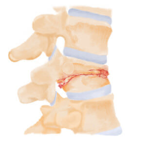 外傷性脊椎骨折(壓迫性骨折)