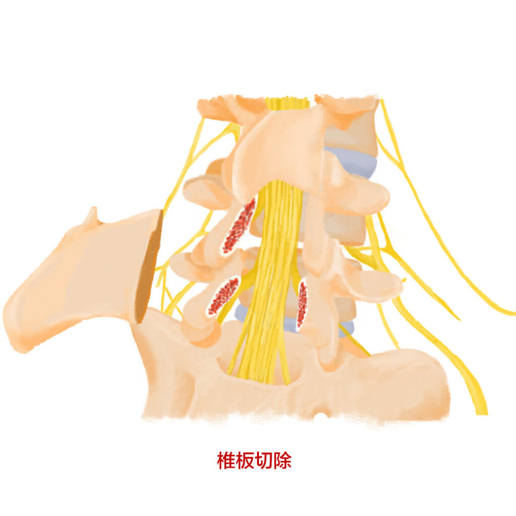 7.1.1-傳統腰椎融合手術B