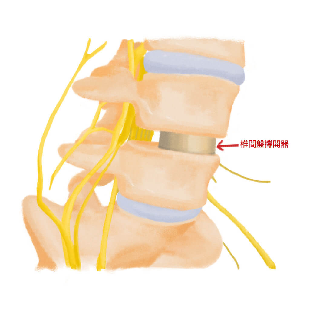 7.1.1-傳統腰椎融合手術C