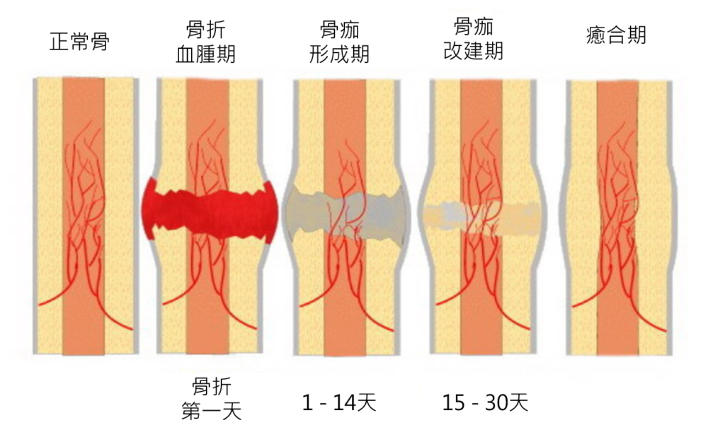 究竟 骨折是如何癒合呢 骨哥論壇