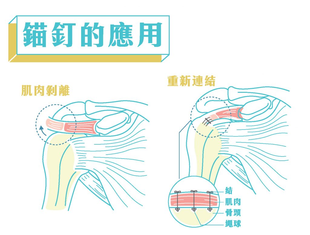 手舉不起來 可能是肩膀筋斷掉 骨哥論壇